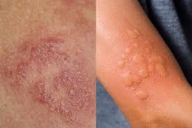 Image result for Hives