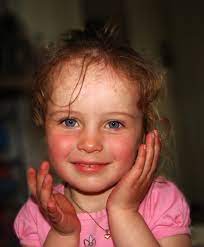 Kinder bis zum schulalter sind am häufigsten von ringelröteln betroffen, aber auch ältere kinder und erwachsene können erkranken. Ringelroteln Erythema Infectiosum Deximed