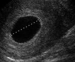 the gestational sac in pregnancy babymed com