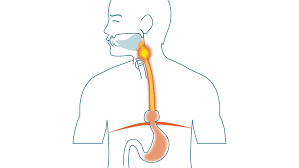 Reflux Disease Gerd Iqoro