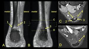 We did not find results for: Distribution Of The Subtendons In The Midportion Of The Achilles Tendon Revealed In Vivo On Mri Scientific Reports