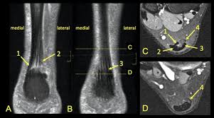 The patient is placed on a moveable bed that is inserted into the magnet. Distribution Of The Subtendons In The Midportion Of The Achilles Tendon Revealed In Vivo On Mri Scientific Reports