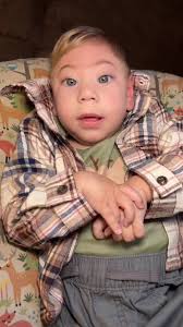 Microcefalia: Maria Luiza e Ana Vitória