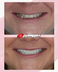 Pacientes que se convierten en amigos 👭. #experienciaprisma 💋.  #prismadental #esteticadental #sonrisasticas #costarica #dentistacostarica