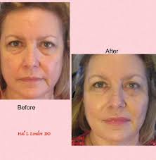 Ol girl got her a face lift after sitting for 10 years