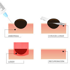 Como Eliminar Un Lunar De Forma Segura Dr Sebastian Podlipnik