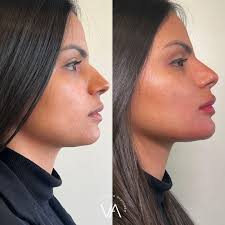 💎 Beleza é poder, e quando você se sente bem, tudo ao seu redor  floresce.🌷 Esse resultado de pós imediato é a prova de que a harmonização  facial não muda quem você