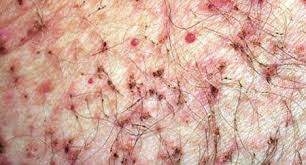 Image result for pubic lice symptoms