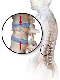 Mild thoracic disc herniation may not cause any signs or symptoms. Vertebral Compression Fractures Symptoms Complications Diagnosis And Treatments