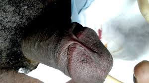 Do not put antiseptics on penis. Dorsal Penile Frenulum A Rare Congenital Abnormality African Journal Of Urology Full Text
