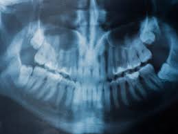 X Ray Of Human Jaw With Teeth Dental Visit X Ray Human Dental