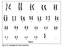 Mosby S Color Atlas And Text Of Pediatrics And Child Health Klinefelter Syndrome Turner Syndrome Syndrome