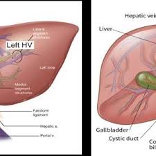 Pdf Retrohepatic Vena Cava Lesion Which We Cannot Forget