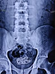 Teenager gets electric cable KNOTTED in his bladder after stuffing it down  his penis in kinky sex game | The Irish Sun