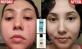 Check spelling or type a new query. Woman Shares Incredible Transformation Photos Using Trader Joe S Skincare Daily Mail Online