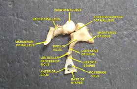 Image result for Ossicular Chain Disruption