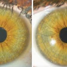 Diffuse Illumination example photo of a participant. Left: image taken...