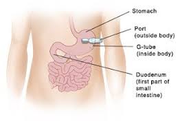 Top 4 Tips To Make The Life Of A Child Going Through Gastrostomy Easy Feeding Tube Awareness Feeding Tube Stomach Tube