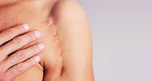 How To Prevent Or Remove Scars | Lovelyskin™