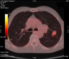 Lung cancer occurs when cells in your lungs begin to grow abnormally as a result of damage to their genetic code (dna). Tuberculosis Mimicking Lung Cancer Sciencedirect