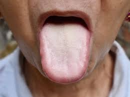Image result for cancer of tongue