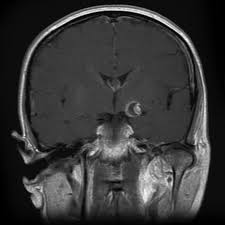 Brain aneurysms are weak areas on the wall of a blood vessel in the brain that become enlarged and can leak or rupture, causing bleeding in the some aneurysms may be visible with mri or ct scans. Saccular Cerebral Aneurysm Radiology Reference Article Radiopaedia Org