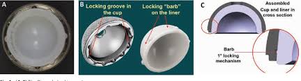 The Incidence Of Dissociated Liners In 4 751 Consecutive Total Hip Arthroplasties Using Pinnacle Polyethylene Acetabular Liners Semantic Scholar