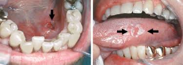 What do the early stages of mouth cancer look like? Throat Cancer Pictures Early Stage Celine Dion Songs Age