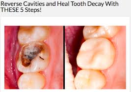Foods that are eaten as part of a meal do less harm to your teeth, as more saliva is produced during. Reverse Cavities And Heal Tooth Decay With Vitamin D Snopes Com
