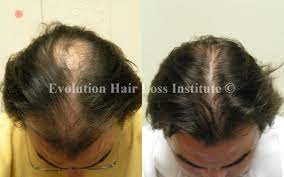 It makes all the other hair loss treatments much more effective. Before And After Hair Growth Treatment Photos