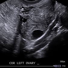 Ultrasound imaging has shown an extremely rapid evolution in the last two decades, thanks to the development of highly. Transvaginal Ultrasound Cedars Sinai