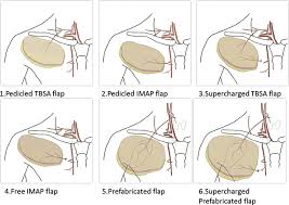 The bones of the chest — namely the rib cage and spine — protect vital organs from injury, and also provide structural support for the body. Different Flap Techniques Of The Anterior Chest Area Tbsa Thoracic Download Scientific Diagram