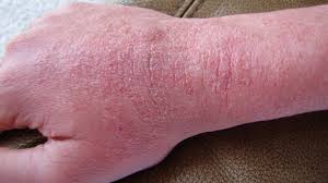 Rash 22 Common Skin Rashes Pictures Causes And Treatment