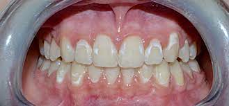 Efficacy Of 4 Year Treatment Of Icon Infiltration Resin On Postorthodontic White Spot Lesions Bmj Case Reports