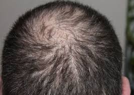 It is really tough when you start seeing your scalp because your hair is already thinning. Hair Loss Breakthrough Human Skin With Hair Created For The First Time Gilmore Health News