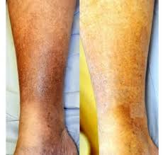 Image result for liver spots on legs