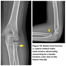 Image result for Elbow XRay