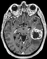 Glioblastoma Multiforme Symptoms Diagnosis And Treatment Options