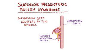 Superior Mesenteric Artery Syndrome Osmosis