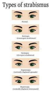 Types Of Strabismus Vector Illustration Medical Knowledge Eye Exercises Medical Student Motivation