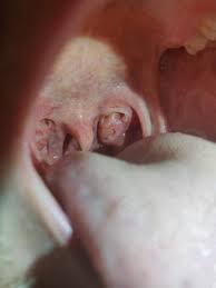 Maybe you would like to learn more about one of these? Abszess Auf Mandel Krebs Gesundheit Und Medizin