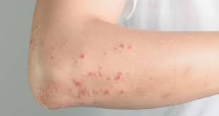 Zona Hastaligi Nedir Belirtileri Nelerdir Saglik Haberleri