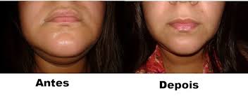 15 famosas que fizeram bichectomia e você nem percebeu no blog do dentista. Fiz Bichectomia A Cirurgia Plastica De Reducao Das Bochechas