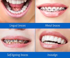 This is about $1,000 less, on average, than metal braces. Looking For The Best Orthodontist In Mill Basin Bensonhurst Or Kings Highway Thinking About Improving Your Smile Jus Ceramic Braces Braces Tips Orthodontics