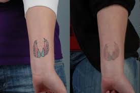 Conway Laser Tattoo Removal Before And After Gallery