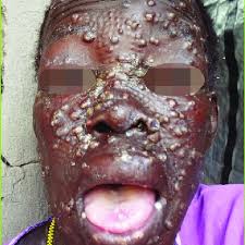 Monkeypox is a viral disease that causes symptoms such as fever, sweating, and a rash with papules and pustules on the face and chest. Monkeypox Severe Avec Atteinte Muqueuse En Republique Democratique Du Download Scientific Diagram