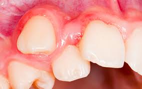 Why Monitoring Jaw Growth Matters for Children's Dental Health