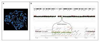 Williams Beuren Syndrome Nejm