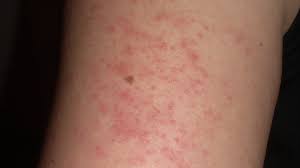In addition to improving the appearance of the keratosis pilaris, laser hair removal can also lead to permanent reduction in hair and a smoother skin overall. Bumps On Arms Causes And Treatment