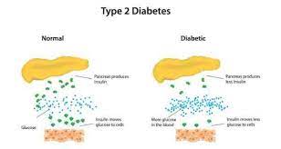 The good news is that many people can stay well using these lifestyle measures. Type 2 Diabetes Risk Factors Symptoms Diagnosis And Treatment